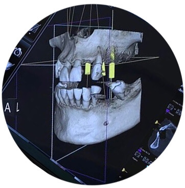 Implantes dentales en Coruña