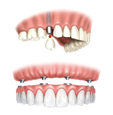 Implantes dentales en Coruña